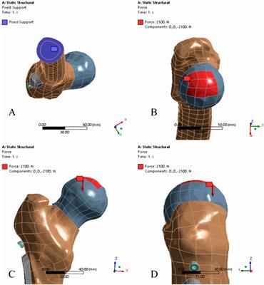 Biomechanical investigation of positive reduction in the femoral neck fracture: a finite element analysis